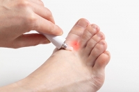 Prevention of Athlete’s Foot