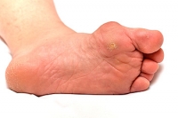 Dealing With Seed Corns on the Foot