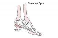 Why Do I Have A Heel Spur?