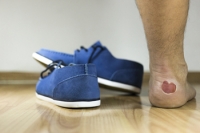 Different Types of Blisters on the Feet